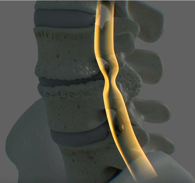 Mild® Procedure for Lower Spinal Stenosis (LSS) | Treat Back & Leg Pain