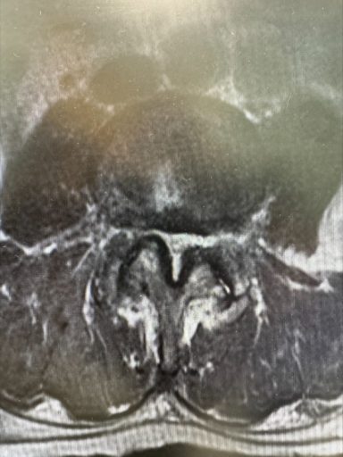 Imaging provided by Dr. Youssef Josephson that shows buckling at the L4-L5 level along with ligamentum flavum hypertrophy - first image