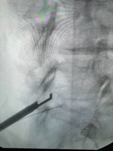 Imaging provided by Dr. Youssef Josephson that shows buckling at the L4-L5 level along with ligamentum flavum hypertrophy - second image